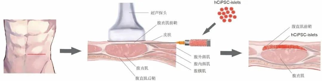 胰島細(xì)胞腹直肌前鞘下移植的示意圖